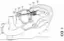 Fig. 09 - Transcatheter atrio-ventricular valve prosthesis
