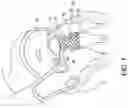 Fig. 12 - Transcatheter atrio-ventricular valve prosthesis