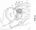 Fig. 13 - Transcatheter atrio-ventricular valve prosthesis