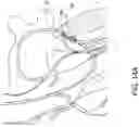 Fig. 29 - Transcatheter atrio-ventricular valve prosthesis