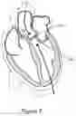Fig. 08 - DEVICES AND METHODS FOR TRANSCATHETER RETRIEVAL OF MECHANICAL HEART VALVE LEAFLETS
