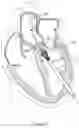 Fig. 10 - DEVICES AND METHODS FOR TRANSCATHETER RETRIEVAL OF MECHANICAL HEART VALVE LEAFLETS