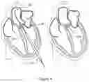 Fig. 11 - DEVICES AND METHODS FOR TRANSCATHETER RETRIEVAL OF MECHANICAL HEART VALVE LEAFLETS