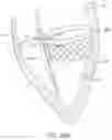 Fig. 20 - System for mitral valve repair and replacement