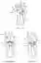 Fig. 44 - System for mitral valve repair and replacement