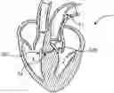 Fig. 01 - System for treating hypertrophic cardiomyopathy and left ventricular outflow tract obstruction