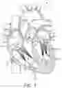 Fig. 02 - System for treating hypertrophic cardiomyopathy and left ventricular outflow tract obstruction