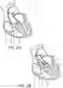 Fig. 03 - System for treating hypertrophic cardiomyopathy and left ventricular outflow tract obstruction