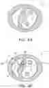 Fig. 05 - System for treating hypertrophic cardiomyopathy and left ventricular outflow tract obstruction