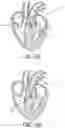 Fig. 06 - System for treating hypertrophic cardiomyopathy and left ventricular outflow tract obstruction
