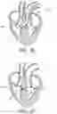 Fig. 08 - System for treating hypertrophic cardiomyopathy and left ventricular outflow tract obstruction