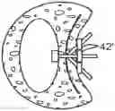 Fig. 01 - Steerable lesion excluding heart implants for congestive heart failure