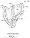 Fig. 02 - Steerable lesion excluding heart implants for congestive heart failure