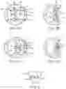 Fig. 03 - Steerable lesion excluding heart implants for congestive heart failure