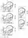 Fig. 05 - Steerable lesion excluding heart implants for congestive heart failure