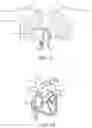 Fig. 09 - Steerable lesion excluding heart implants for congestive heart failure
