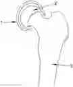 Fig. 01 - Hip interpositional spacer