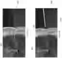 Fig. 16 - Systems and methods for nasal support