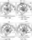 Fig. 74 - Medical device for sensing and or stimulating tissue