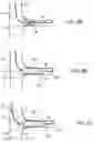 Fig. 04 - Balloon catheters and methods for use