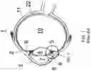 Fig. 02 - Surgical system and procedure for precise intraocular pressure reduction