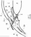 Fig. 03 - Surgical system and procedure for precise intraocular pressure reduction