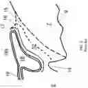 Fig. 04 - Surgical system and procedure for precise intraocular pressure reduction
