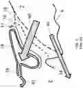 Fig. 05 - Surgical system and procedure for precise intraocular pressure reduction