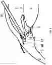 Fig. 07 - Surgical system and procedure for precise intraocular pressure reduction