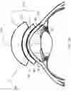 Fig. 15 - Surgical system and procedure for precise intraocular pressure reduction