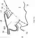 Fig. 17 - Surgical system and procedure for precise intraocular pressure reduction