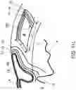 Fig. 18 - Surgical system and procedure for precise intraocular pressure reduction