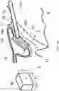 Fig. 21 - Surgical system and procedure for precise intraocular pressure reduction
