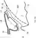 Fig. 22 - Surgical system and procedure for precise intraocular pressure reduction