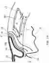 Fig. 23 - Surgical system and procedure for precise intraocular pressure reduction