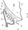Fig. 25 - Surgical system and procedure for precise intraocular pressure reduction