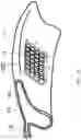 Fig. 26 - Surgical system and procedure for precise intraocular pressure reduction