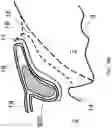 Fig. 28 - Surgical system and procedure for precise intraocular pressure reduction