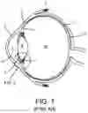Fig. 02 - Surgical system and procedure for treatment of the trabecular meshwork and Schlemm's canal using a femtosecond laser