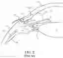 Fig. 03 - Surgical system and procedure for treatment of the trabecular meshwork and Schlemm's canal using a femtosecond laser