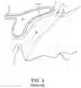Fig. 04 - Surgical system and procedure for treatment of the trabecular meshwork and Schlemm's canal using a femtosecond laser