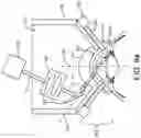 Fig. 10 - Surgical system and procedure for treatment of the trabecular meshwork and Schlemm's canal using a femtosecond laser