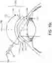 Fig. 15 - Surgical system and procedure for treatment of the trabecular meshwork and Schlemm's canal using a femtosecond laser