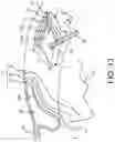 Fig. 18 - Surgical system and procedure for treatment of the trabecular meshwork and Schlemm's canal using a femtosecond laser