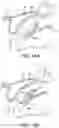 Fig. 19 - Surgical system and procedure for treatment of the trabecular meshwork and Schlemm's canal using a femtosecond laser