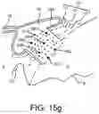 Fig. 23 - Surgical system and procedure for treatment of the trabecular meshwork and Schlemm's canal using a femtosecond laser