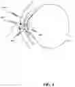 Fig. 05 - Ocular shield for facilitating generation of visual evoked potentials (VEP)