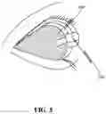 Fig. 06 - Ocular shield for facilitating generation of visual evoked potentials (VEP)
