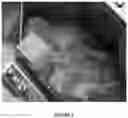 Fig. 04 - Intraoperative topically-applied non-implantable rapid release patch