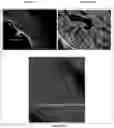 Fig. 06 - Intraoperative topically-applied non-implantable rapid release patch